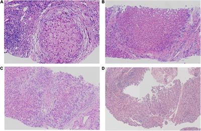 Case series of progressive familial intrahepatic cholestasis type 3: Characterization of variants in ABCB4 in China